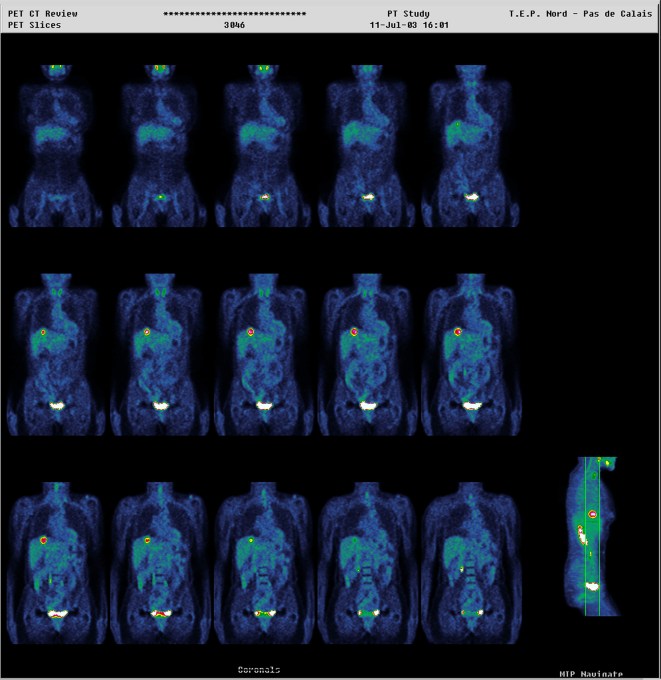 Rectal Carcinoma GettyImages 151045631